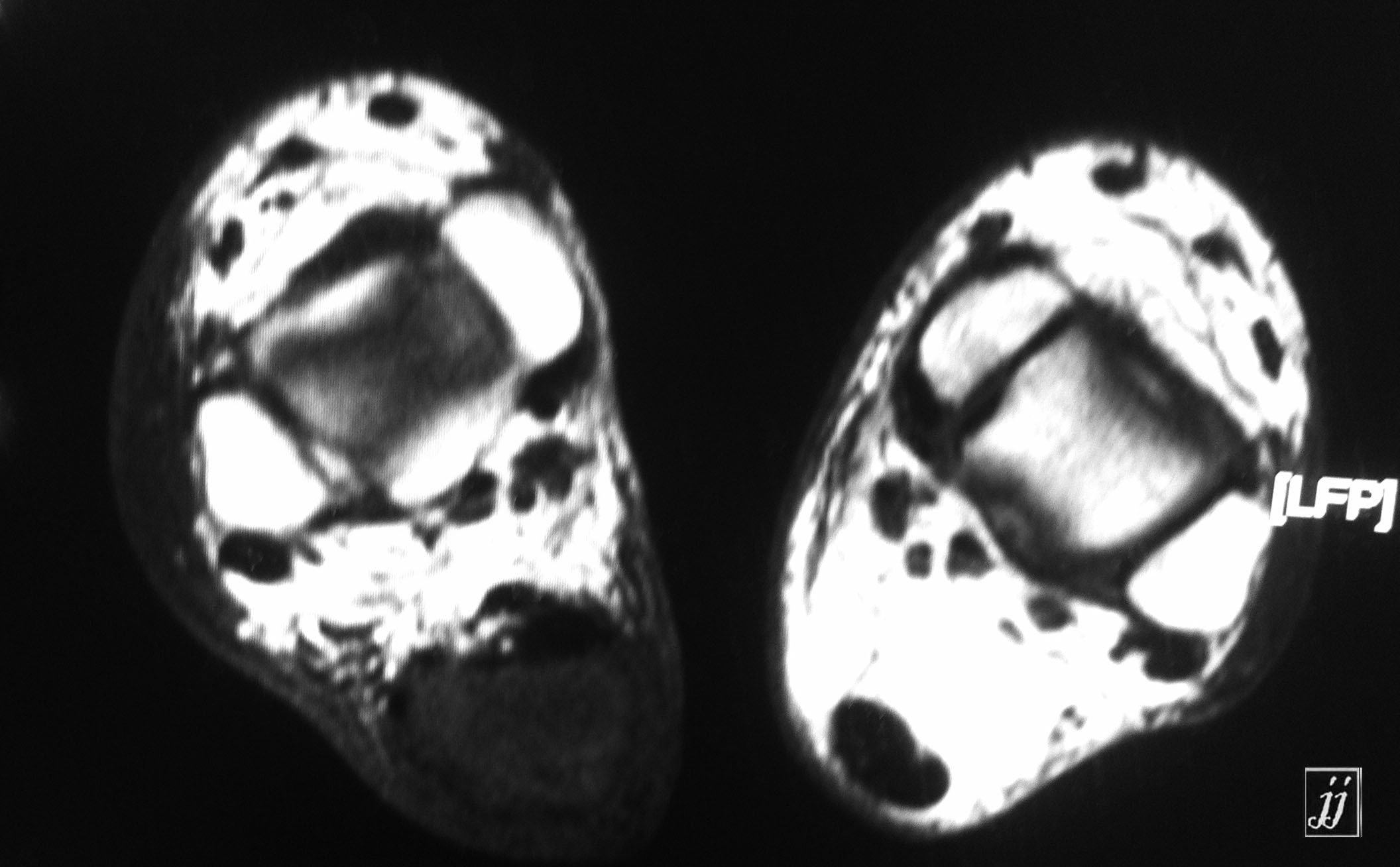 Radioogle | MSK- giant achille tendon ganglion cyst (1)