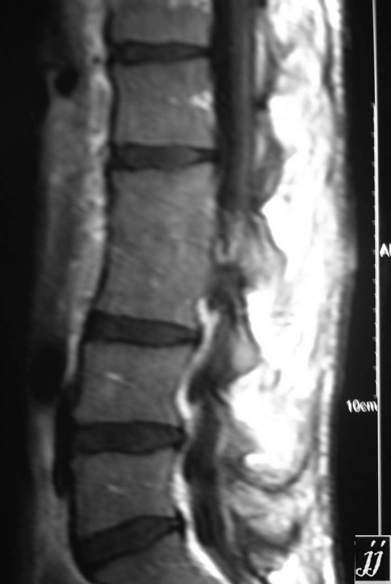 Spine- Psoas Muscle Abscess (tuberculosis) And Fused Vertebra (3 