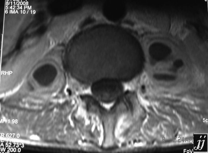 Muscle Abscess Mri Spine- psoas muscle abscess (tuberculosis) and fused vertebra (5 ...