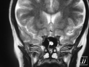 Brain- Cavernoma