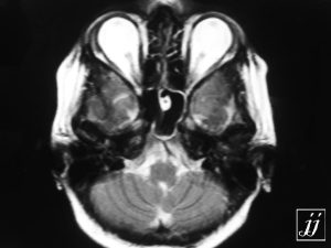 Brain- Cavernoma