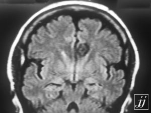 Brain- Cavernoma