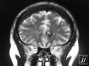 Brain- Cavernoma