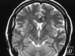 Brain- Cavernoma