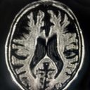 Brain- severe brain atrophy