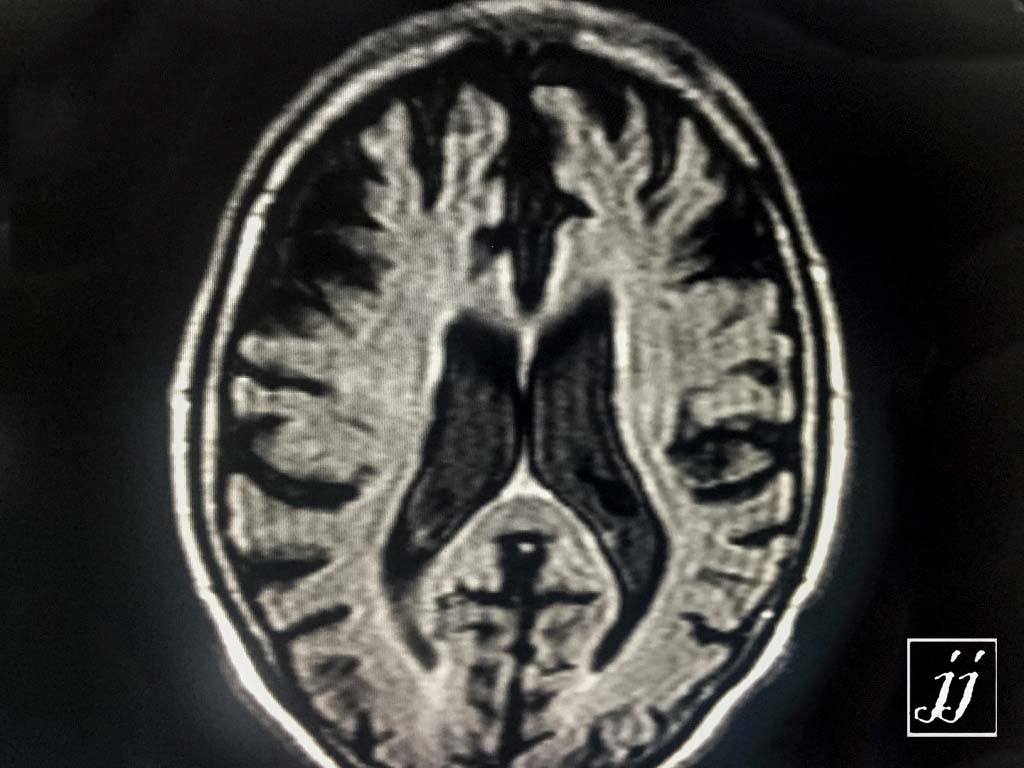Brain- severe brain atrophy