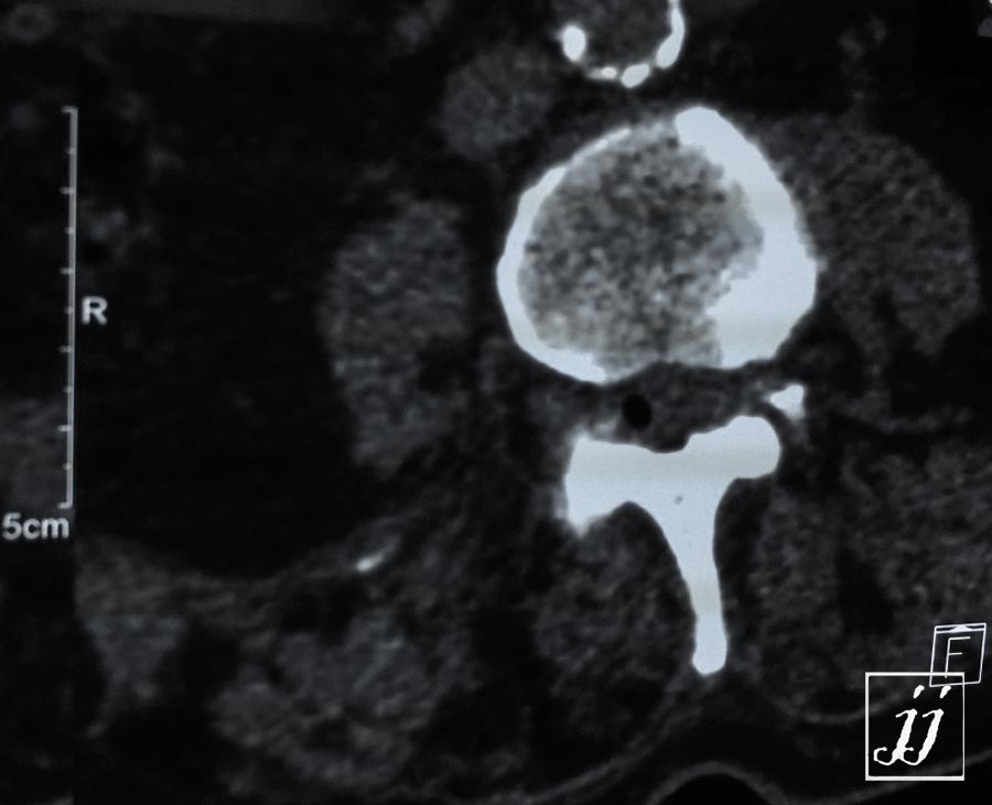 Radioogle | Spine- abdominal aorta medial sclerosis