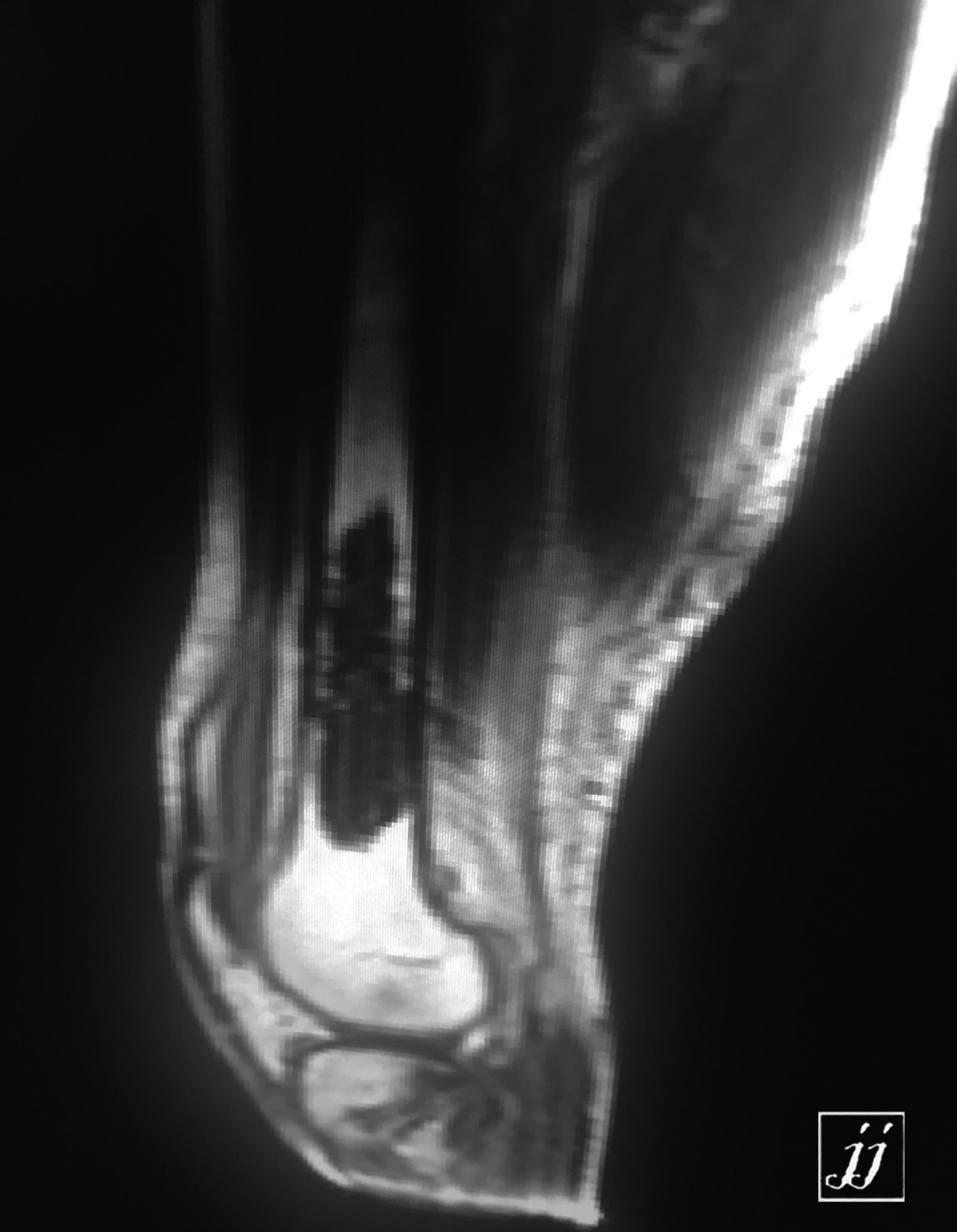 Radioogle | MSK- distal femoral shaft sclerotic lesion with joint ...