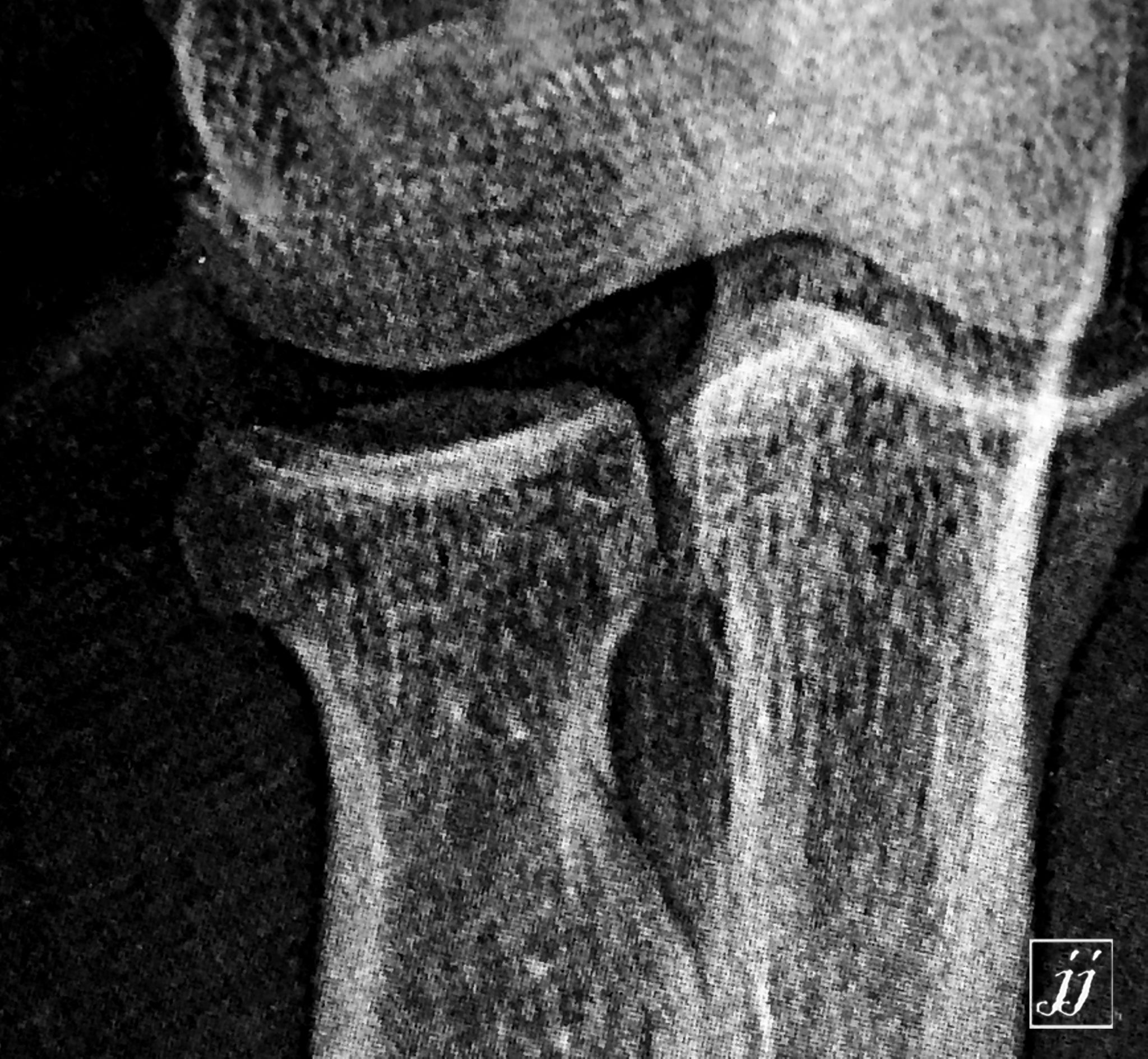 MSK- elbow joint effusion and radial head fracture with joint ...
