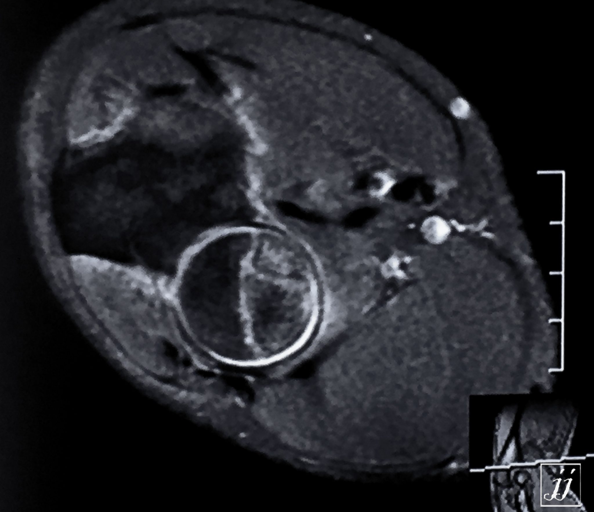 MSK- elbow joint effusion and radial head fracture with joint ...