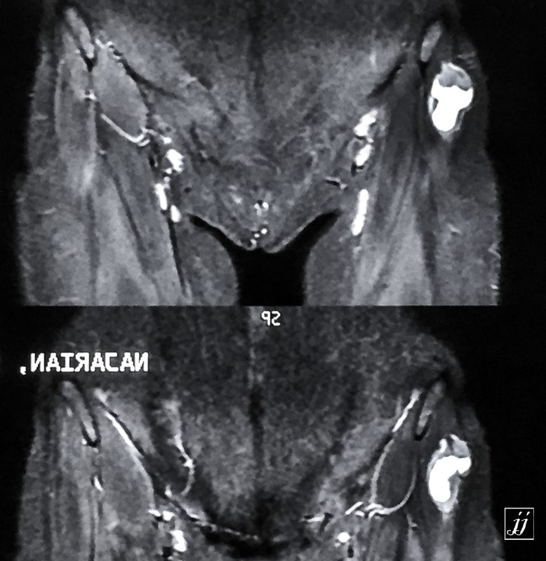 MSK- right inguinal node with abscess with cellulitis (1) - Radioogle