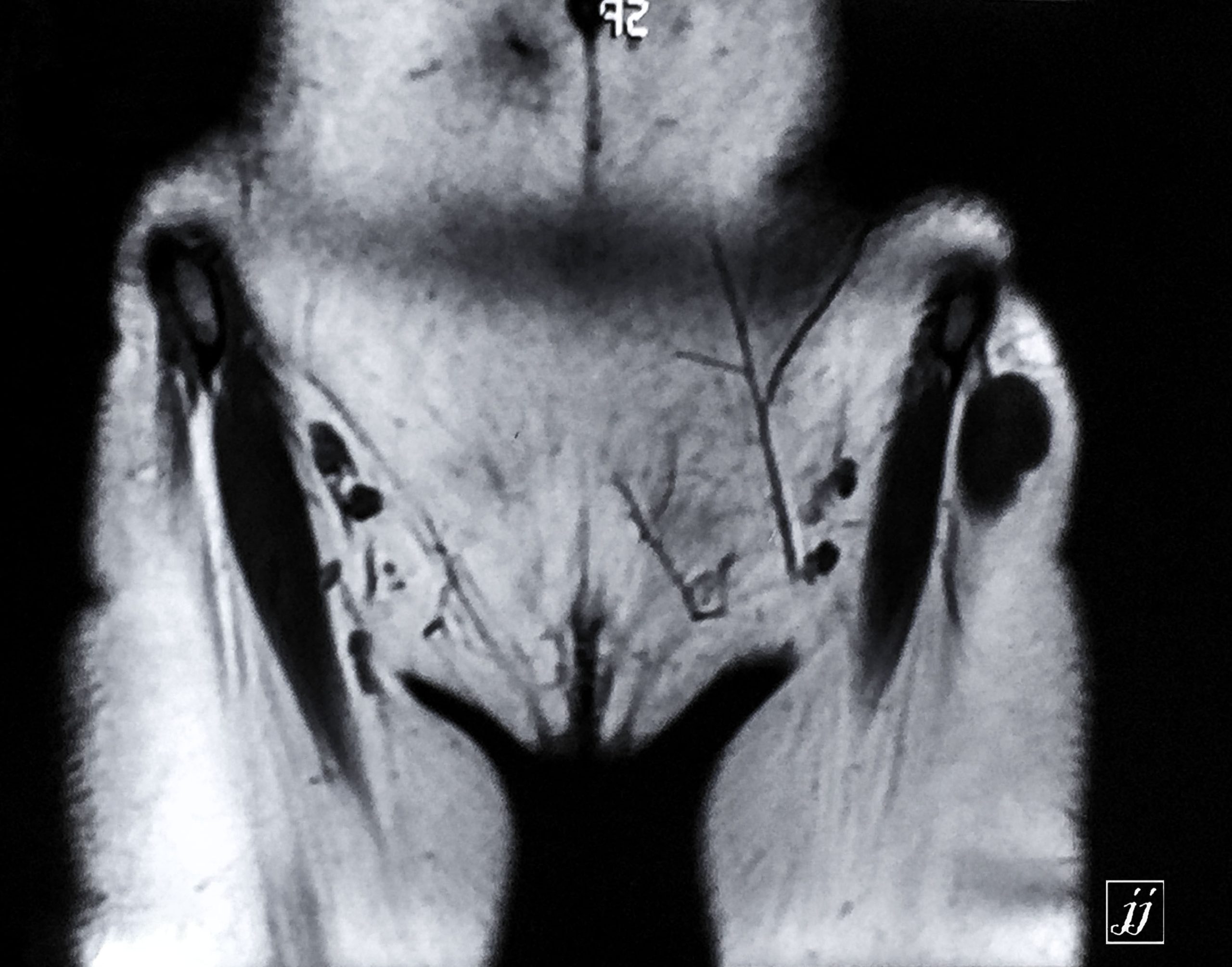 MSK- right inguinal node with abscess with cellulitis (4) - Radioogle