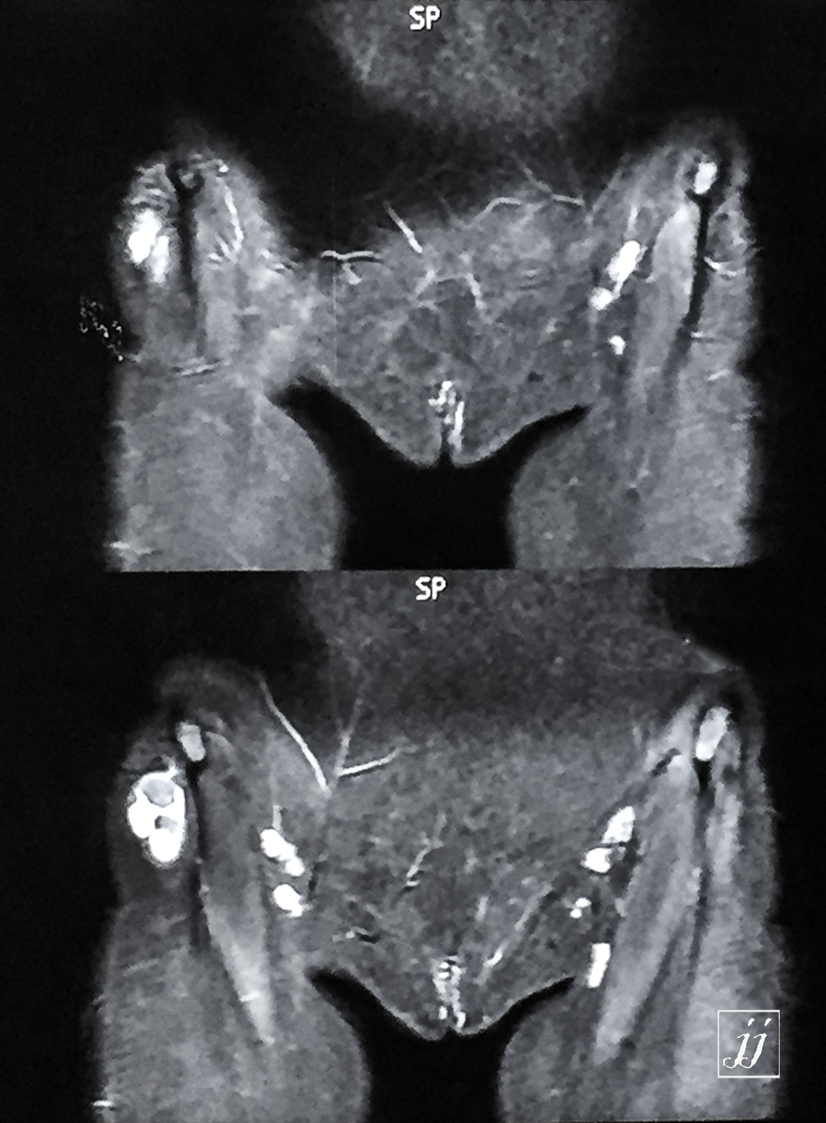 MSK- right inguinal node with abscess with cellulitis (5) - Radioogle